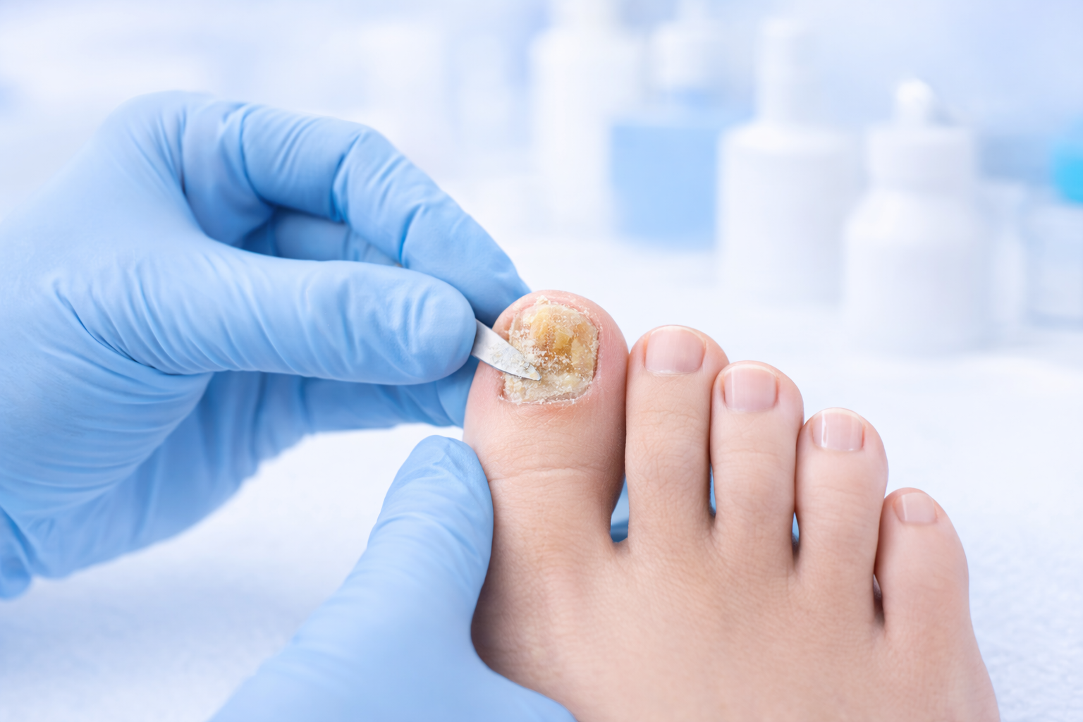 Nagelpilzbehandlung